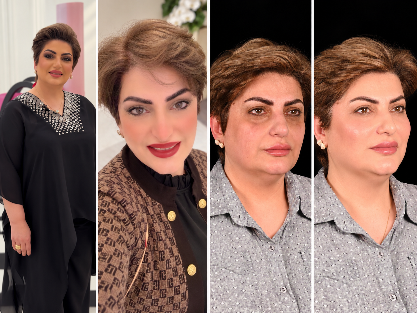 الفنانة امل محمد بلام بعيادة دكتورة شاهي بعد وقبل تجميل البشرة الكويت