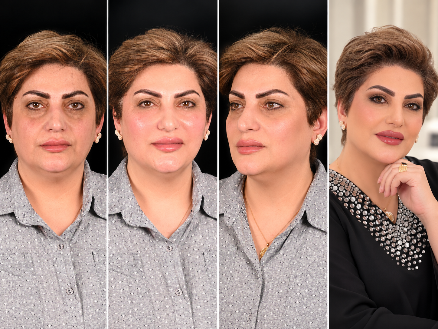 الفنانة امل محمد بلام بعيادة دكتورة شاهي بعد وقبل تجميل البشرة بالكويت