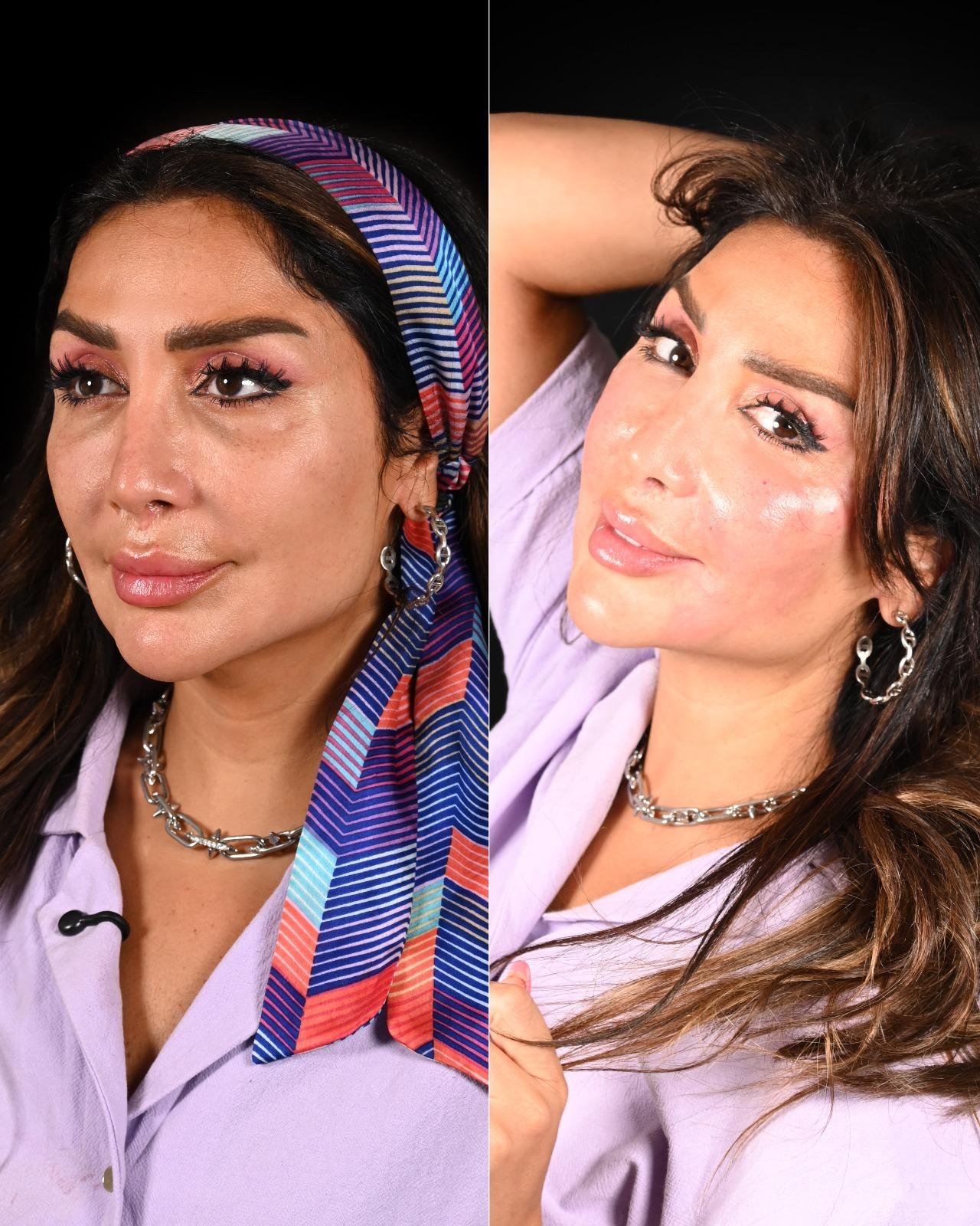 هدي حمدان بعيادة د شاهي بعد وقبل تجميل البشرة